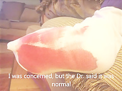 Brachymetatarsia Sexy Feet